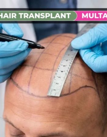 Dot Clinics Hair Transplant