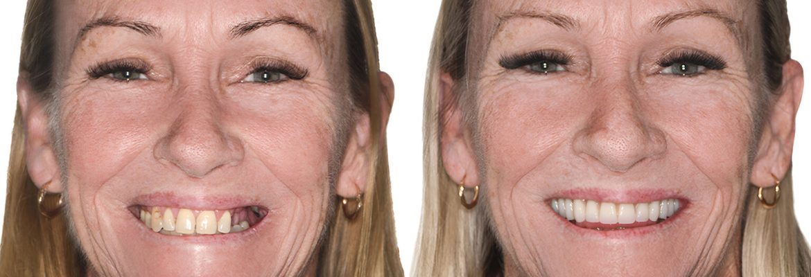 My Implant Dentist South Perth